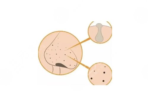 去黑頭收縮毛孔好的方法有哪些？