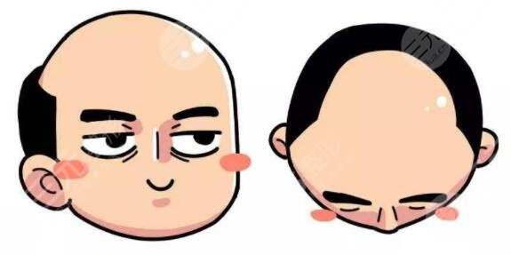 上海緩解脫發(fā)多少錢2023？藥物、手術、日常護理多方位入手，解救禿頭星人！