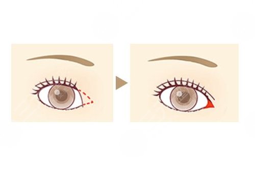 開內(nèi)眼角一般多少錢？