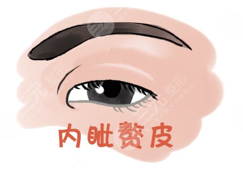 開內(nèi)眼角一般多少錢？