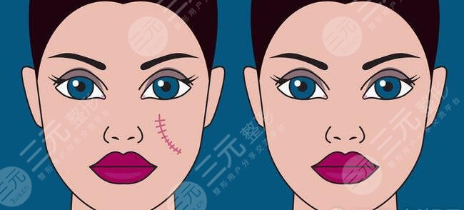 像素激光去疤效果怎么樣？要做多少次才行？技術(shù)優(yōu)點(diǎn)及是否安全？