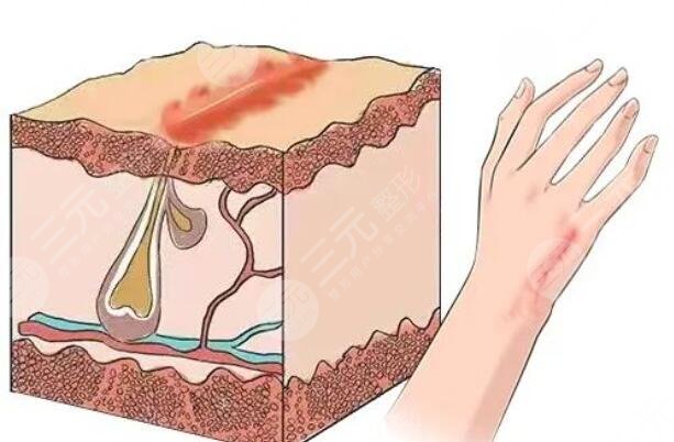 像素激光祛疤的優(yōu)點(diǎn)有哪些?