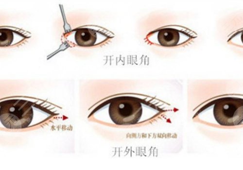 一般開內(nèi)眼角多少錢?