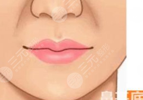 鼻基底注射玻尿酸會移位嗎？