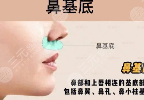 鼻基底注射玻尿酸會移位嗎？