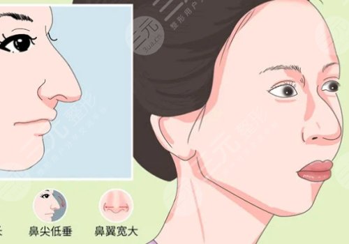 駝峰鼻矯正手術(shù)多少錢？