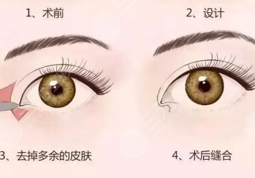 開眼角加割雙眼皮一共多少錢?