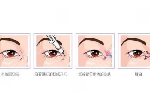 開眼角加割雙眼皮一共多少錢?