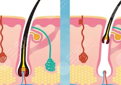 激光脫毛和冰點脫毛哪個好？
