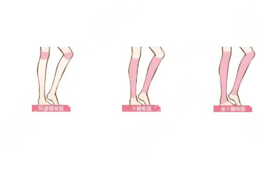 小腿吸脂恢復(fù)期要多久？有效果嗎？