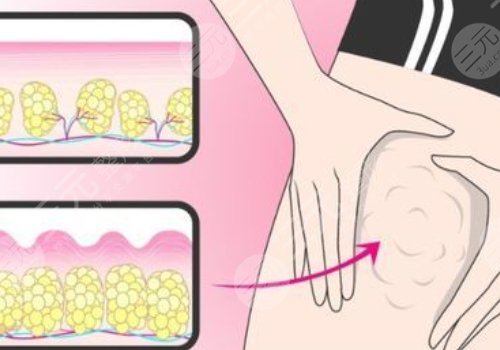 小腿吸脂恢復(fù)期要多久？有效果嗎？