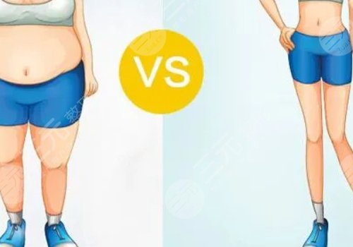 小腿吸脂恢復(fù)期要多久？有效果嗎？