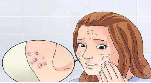 怎樣才能去除青春痘方法簡單有效？網友和網紅測評的8種小技巧，快來get