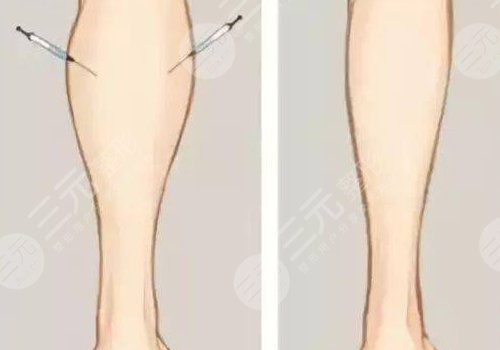 怎樣瘦腿又快又有效？