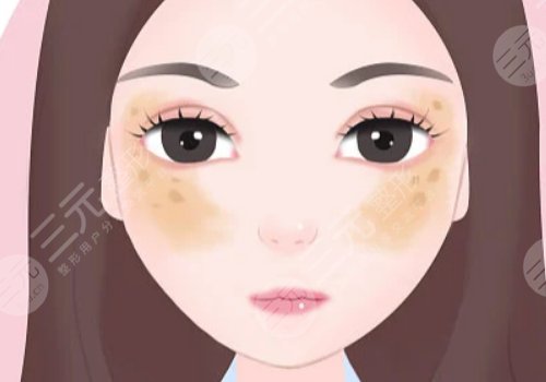 激光祛斑會不會反彈？需要做幾次？