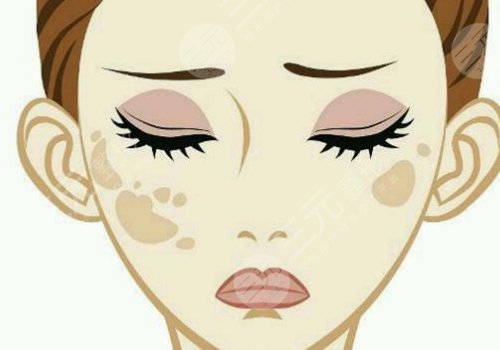 激光祛斑會不會反彈？需要做幾次？