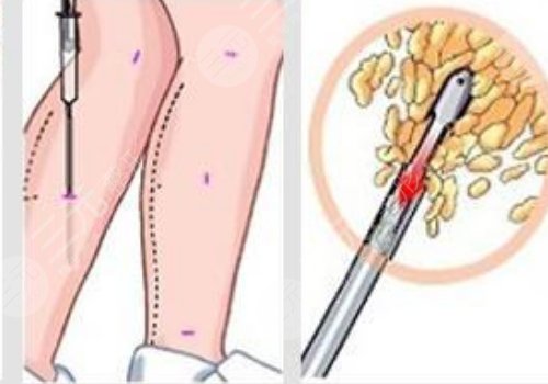 小腿吸脂后多久可以正常走路？