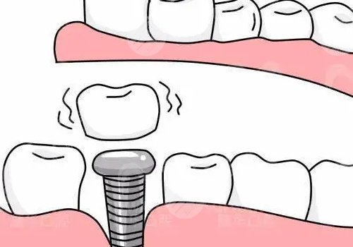 種植牙瑞士瑞典哪個好？