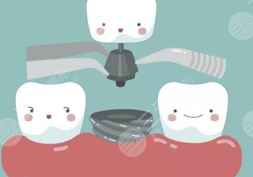 種植牙瑞士瑞典哪個好？