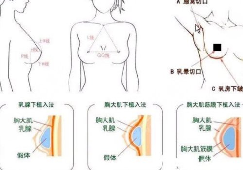 豐胸手術(shù)對(duì)身體有什么影響？