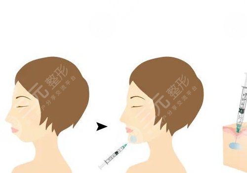 寶尼達玻尿酸適合注射在什么部位？