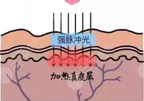 深藍射頻和光子嫩膚哪個好？