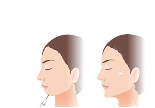 艾莉薇傳奇玻尿酸維持多久？