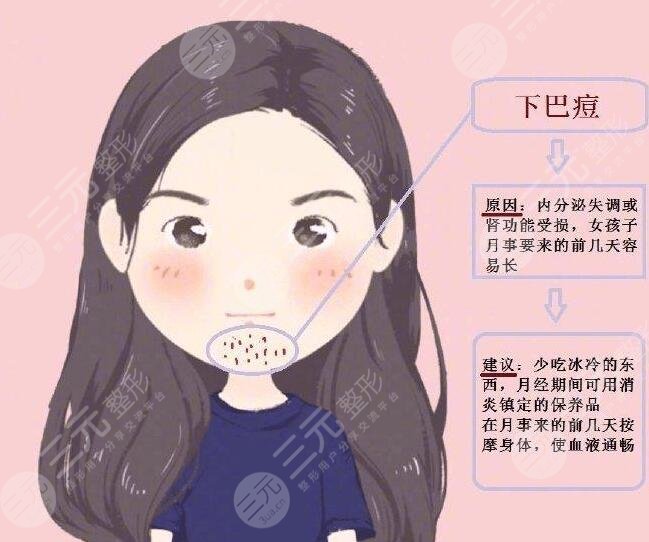 激光祛痘需要多長(zhǎng)時(shí)間能徹底恢復(fù)好？需要緩解幾次？療程是多久？