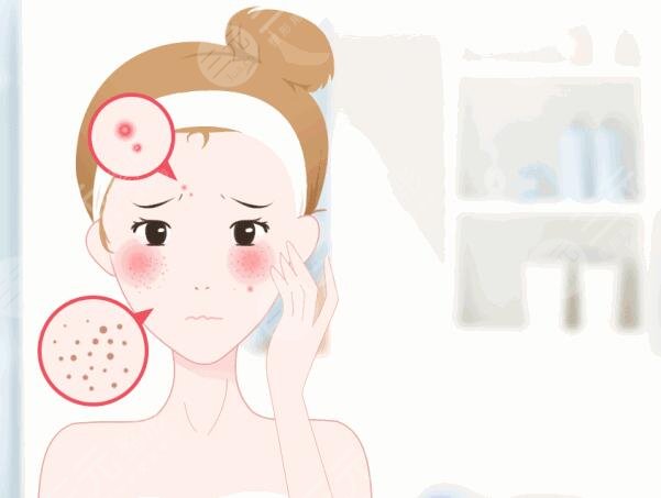 激光祛痘需要多長(zhǎng)時(shí)間才能看到效果?