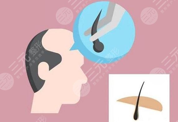 毛發(fā)種植的費用是多少2023？價格影響根源所在，30秒速覽~