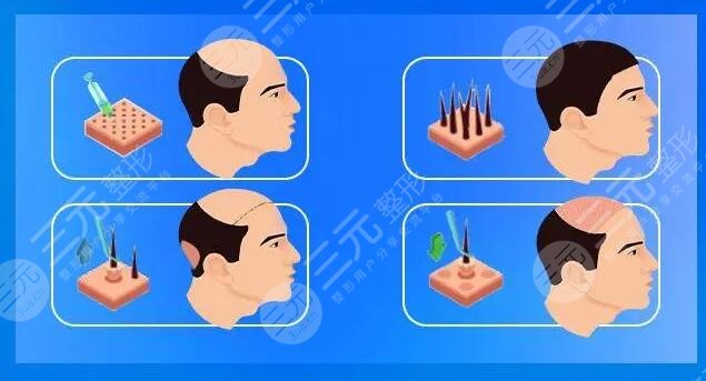 影響植發(fā)價格選擇因素