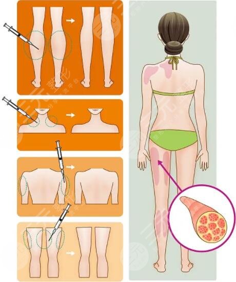 溶脂減肥手術(shù)優(yōu)點(diǎn)