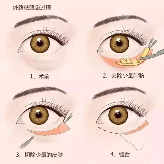 眼袋是怎么產(chǎn)生的？如何消除眼袋？