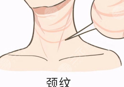 頸紋怎么消除?