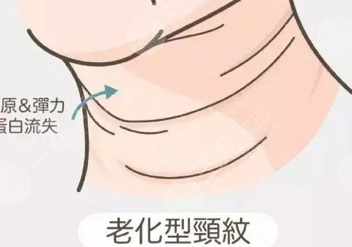 頸紋怎么消除?