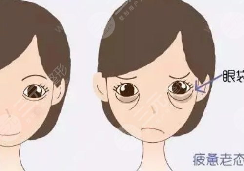 眼袋怎么消除？