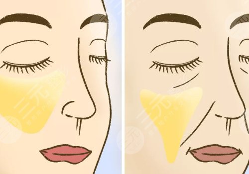 7d聚拉提美容的功效和副作用有哪些？