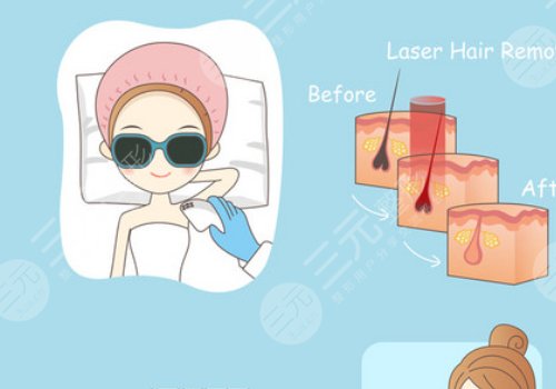 激光脫毛和冰點(diǎn)脫毛有什么區(qū)別？