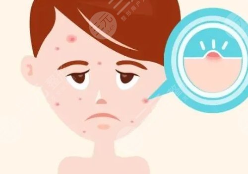 口周一直長(zhǎng)痘痘什么原因？