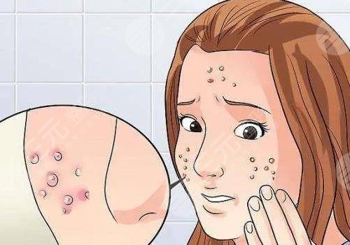 臉上痘坑怎么去除？