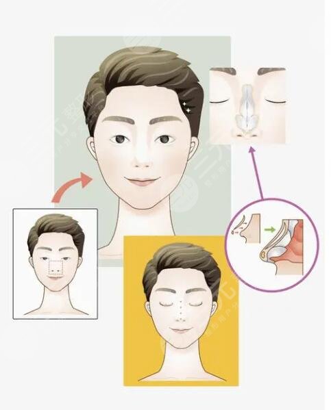 李愛林做鼻子怎么樣？醫(yī)生資料詳情、手術風格夸張嗎？整友術后反饋來襲~