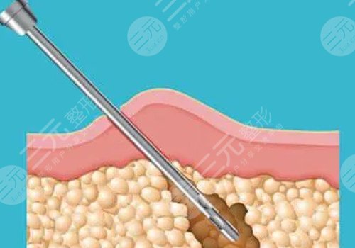 杭州連天美脂肪填充怎么樣？
