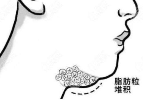 超聲炮下頜緣有必要做嗎？