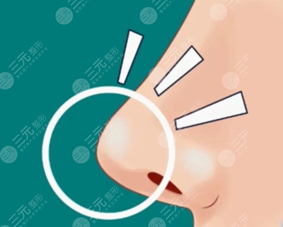 玻尿酸隆鼻有副作用嗎？該怎么避免玻尿酸隆鼻的副作用呢？