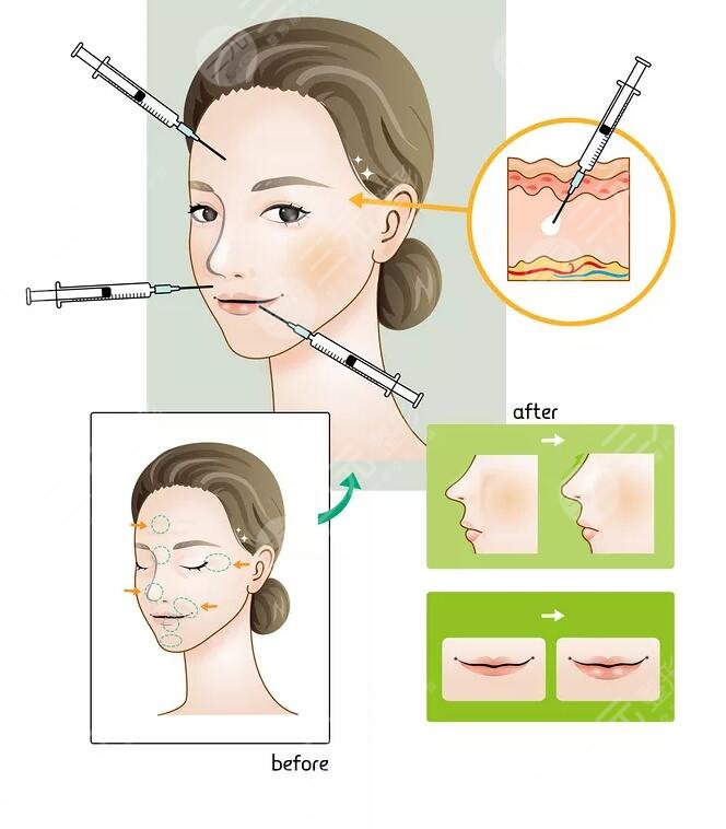 玻尿酸隆鼻的效果及注意事項