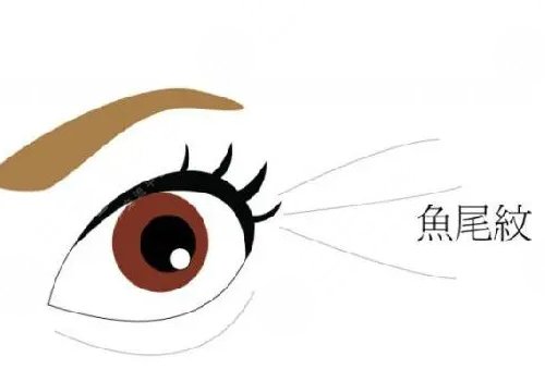 魚(yú)尾紋手術(shù)哪種好？