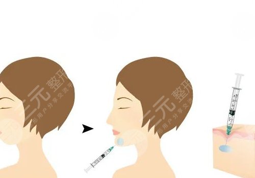 自體脂肪隆下巴多少錢？