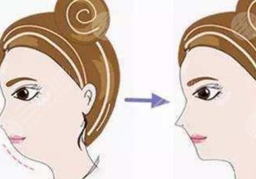 自體脂肪隆下巴多少錢？