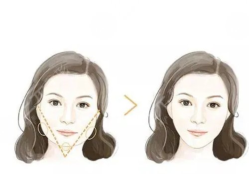 自體脂肪隆下巴多少錢？