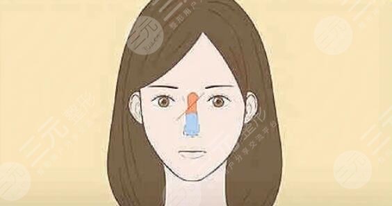 隆鼻整形手術(shù)